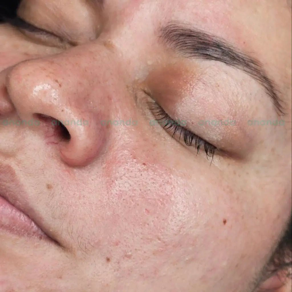 Limpieza facial profunda